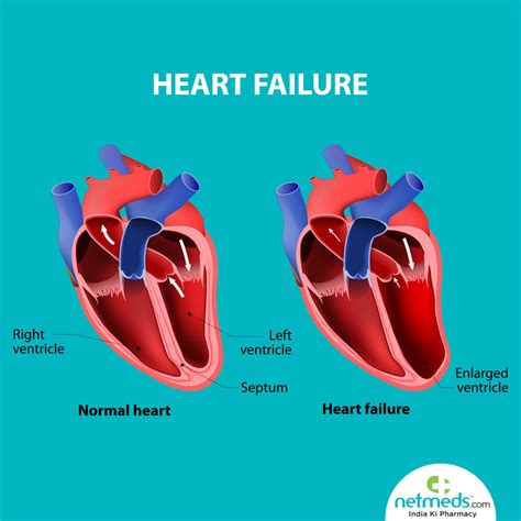 left ventricular failure pdf